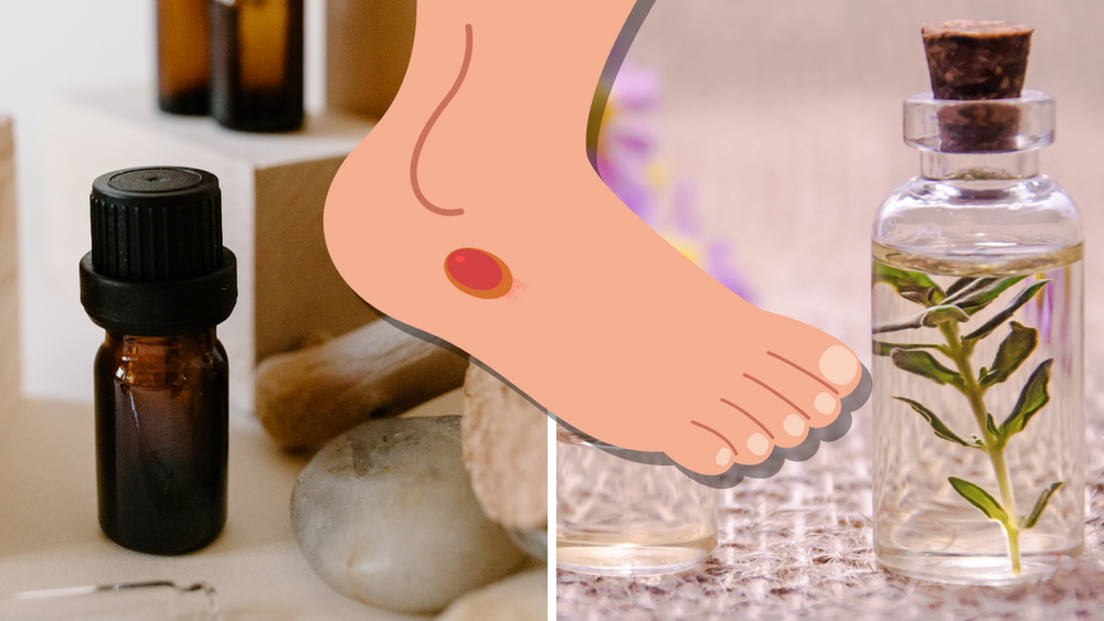 essential oils for blisters, image by canva