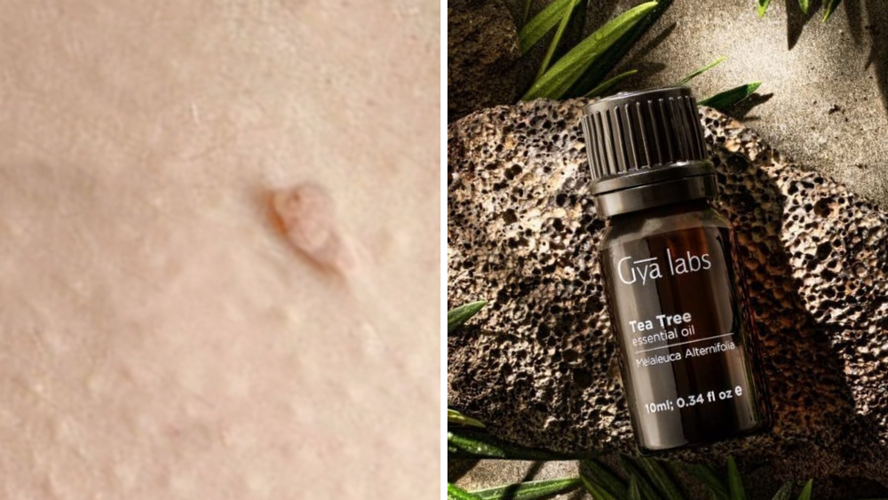 skin tag image and gya labs tea tree oil (amazon)
