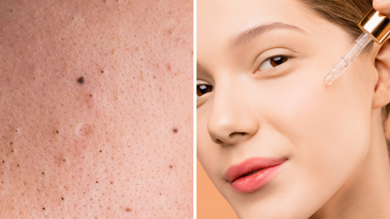 essential oils for blackheads- photo (left) by Shiny Diamond on pexels.com