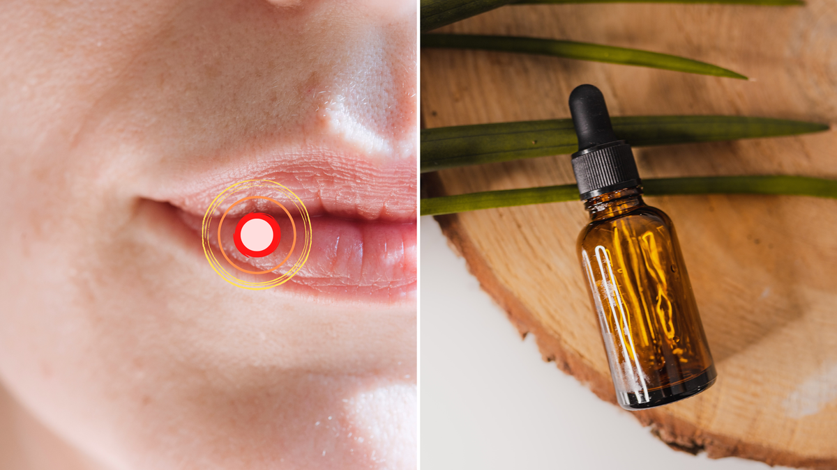 Goodbye Canker Sores 10 Essential Oils That Will End the Pain