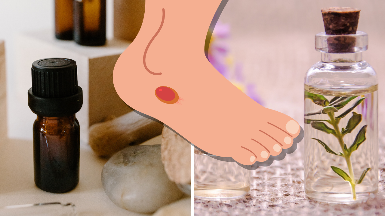 7 Essential Oils for Blisters A Smoother Solution for Your Skin!